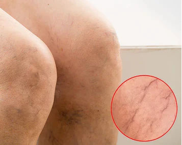 Varicose Veins